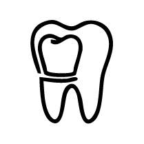 Cantilever Dental Bridges