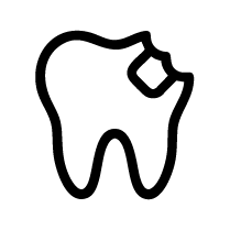 Chipped Tooth Composite Repair