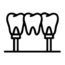 Implant Supported Dentures